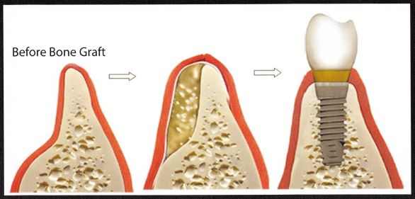 Bone graft before and after.