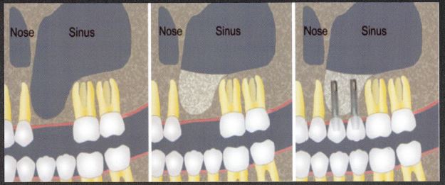 Sinus augmentation before and after.
