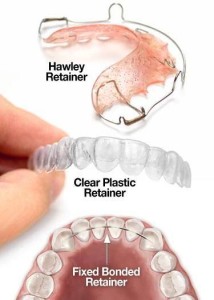 Examples of three different types of retainers.