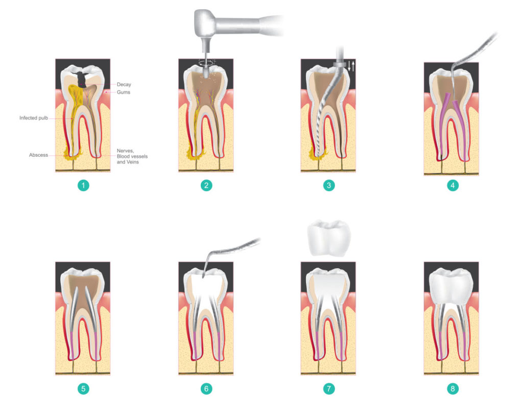 Root Canal Therapy Ismile Dental 6999